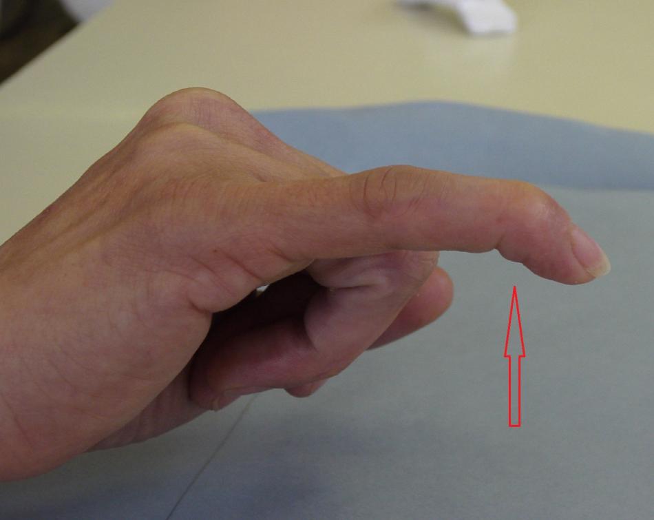 mallet finger et jersey finger pathologies et operations doigts